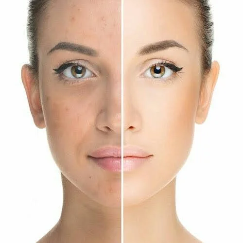 Zdjęcie kobiety przedzielone na pół - pierwsza połowa przed zabiegiem peeling glyco exfoliant - druga część po zabiegu - skóra znacznie gładsza, bez przebarwień.