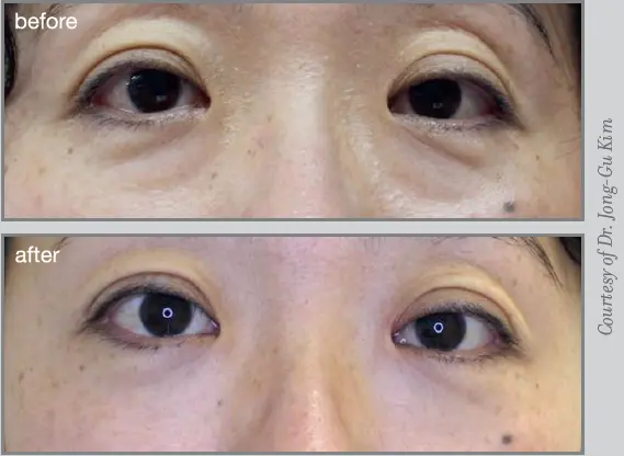 Zdjęcie przedstawiające efekt zabiegu estetycznego okolic oczu. Na górze widoczne oczy przed zabiegiem z opadającymi powiekami i workami pod oczami, na dole oczy po zabiegu – skóra jest gładsza, powieki uniesione, a spojrzenie bardziej otwarte.